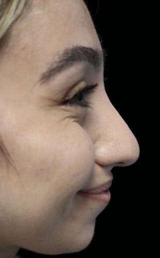 Beverly Hills Rhinoplasty Before & After Gallery - Patient 272534 - Image 12 Dr. Deepak Raj Dugar