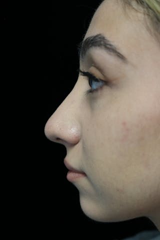 Beverly Hills Rhinoplasty Before & After Gallery - Patient 272534 - Image 14 Dr. Deepak Raj Dugar