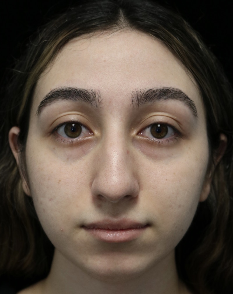 Beverly Hills Rhinoplasty Before & After Gallery - Patient 272534 - Image 3 Dr. Deepak Raj Dugar