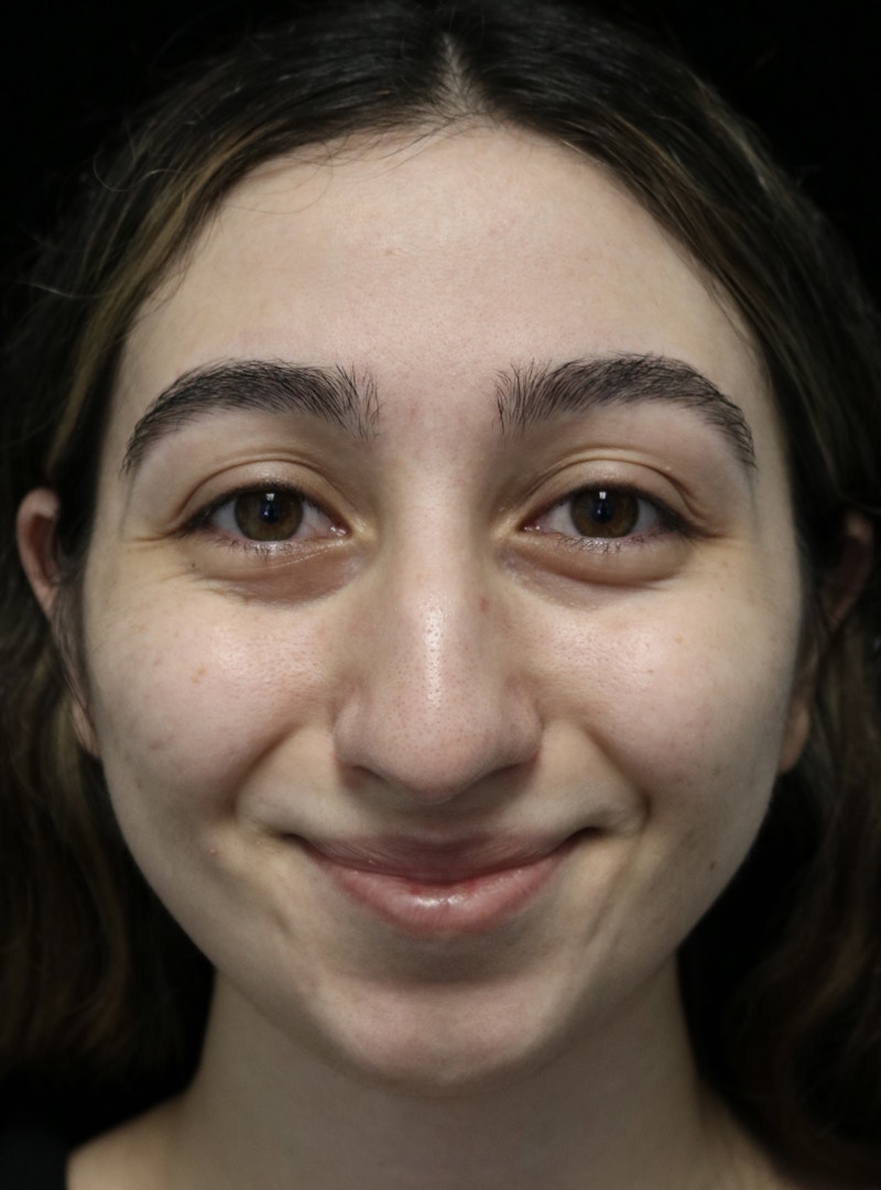 Beverly Hills Rhinoplasty Before & After Gallery - Patient 272534 - Image 5 Dr. Deepak Raj Dugar