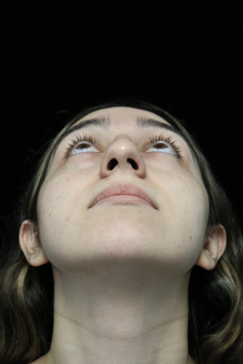 Beverly Hills Rhinoplasty Before & After Gallery - Patient 272534 - Image 7 Dr. Deepak Raj Dugar