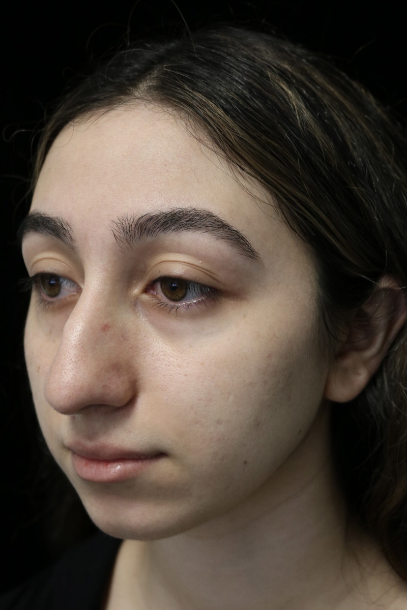 Beverly Hills Rhinoplasty Before & After Gallery - Patient 272534 - Image 9 Dr. Deepak Raj Dugar