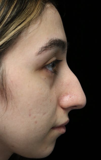 Beverly Hills Rhinoplasty Before & After Gallery - Patient 272534 - Image 1 Dr. Deepak Raj Dugar