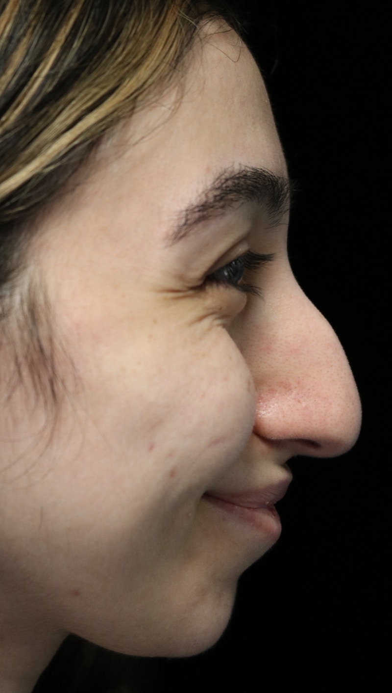 Beverly Hills Rhinoplasty Before & After Gallery - Patient 272534 - Image 11 Dr. Deepak Raj Dugar