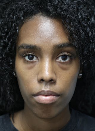 Beverly Hills Rhinoplasty Before & After Gallery - Patient 165692 - Image 4 Dr. Deepak Raj Dugar