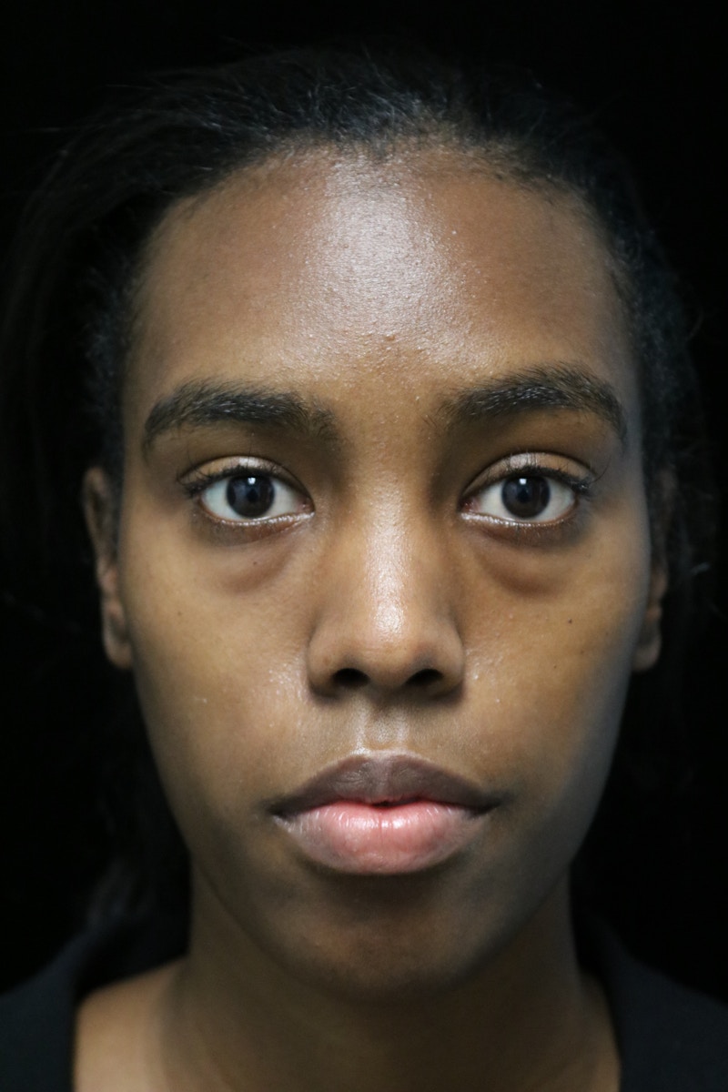 Beverly Hills Rhinoplasty Before & After Gallery - Patient 165692 - Image 3 Dr. Deepak Raj Dugar