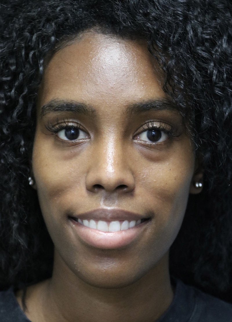 Beverly Hills Rhinoplasty Before & After Gallery - Patient 165692 - Image 6 Dr. Deepak Raj Dugar