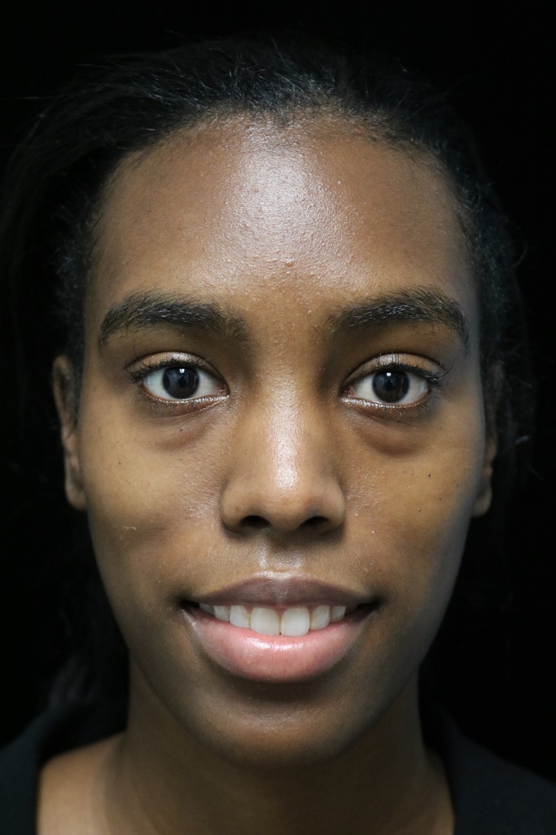 Beverly Hills Rhinoplasty Before & After Gallery - Patient 165692 - Image 5 Dr. Deepak Raj Dugar