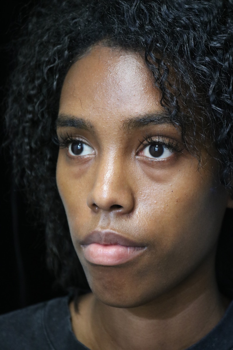 Beverly Hills Rhinoplasty Before & After Gallery - Patient 165692 - Image 10 Dr. Deepak Raj Dugar