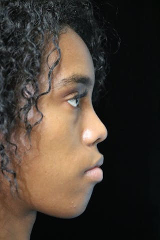 Beverly Hills Rhinoplasty Before & After Gallery - Patient 165692 - Image 2 Dr. Deepak Raj Dugar