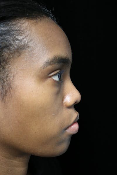 Beverly Hills Rhinoplasty Before & After Gallery - Patient 165692 - Image 1 Dr. Deepak Raj Dugar