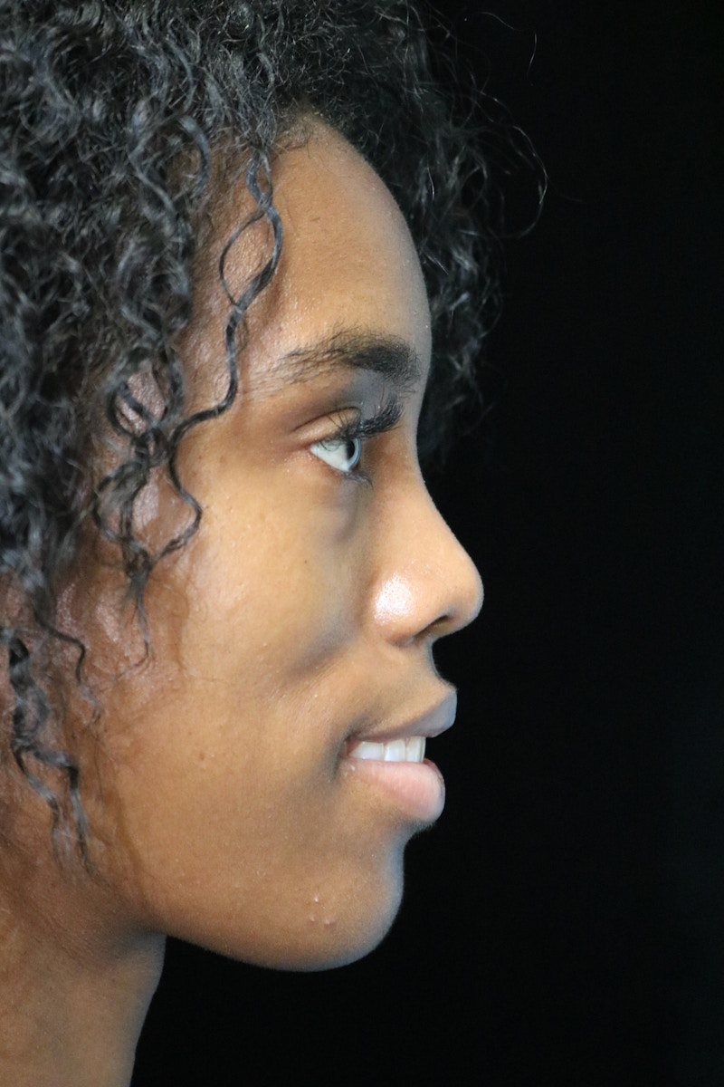 Beverly Hills Rhinoplasty Before & After Gallery - Patient 165692 - Image 12 Dr. Deepak Raj Dugar