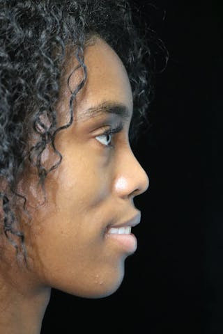 Beverly Hills Rhinoplasty Before & After Gallery - Patient 165692 - Image 12 Dr. Deepak Raj Dugar