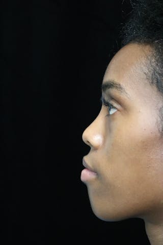 Beverly Hills Rhinoplasty Before & After Gallery - Patient 165692 - Image 14 Dr. Deepak Raj Dugar