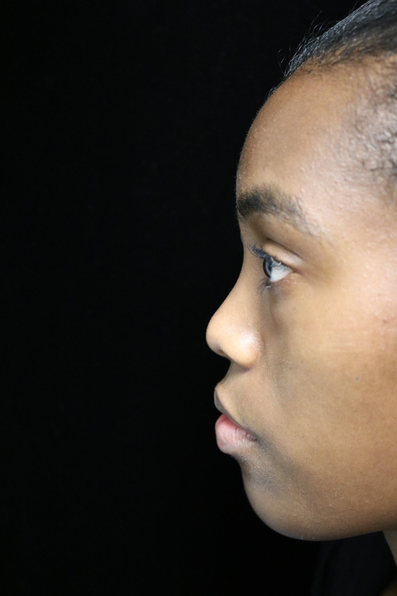 Beverly Hills Rhinoplasty Before & After Gallery - Patient 165692 - Image 13 Dr. Deepak Raj Dugar