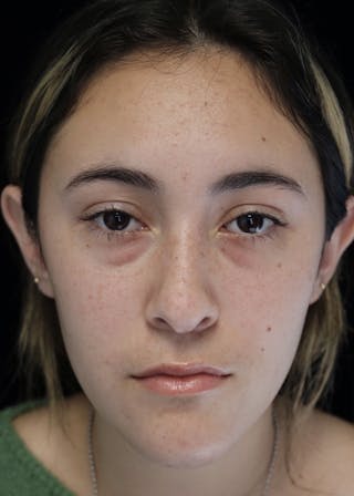 Beverly Hills Rhinoplasty Before & After Gallery - Patient 910591 - Image 4 Dr. Deepak Raj Dugar
