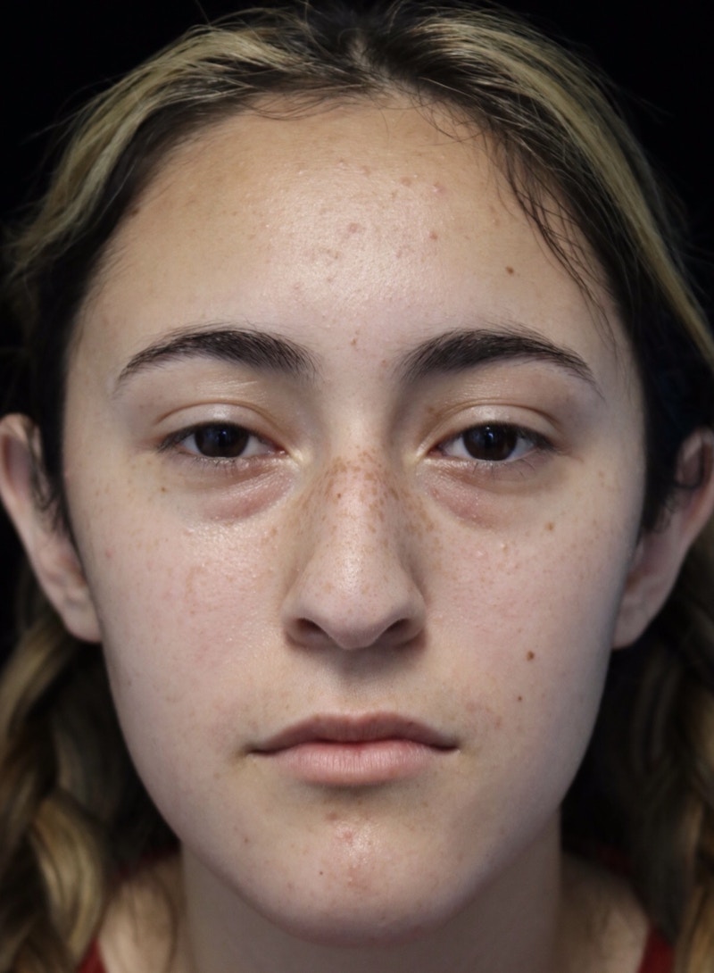 Beverly Hills Rhinoplasty Before & After Gallery - Patient 910591 - Image 3 Dr. Deepak Raj Dugar