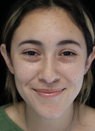 Beverly Hills Rhinoplasty Before & After Gallery - Patient 910591 - Image 6 Dr. Deepak Raj Dugar