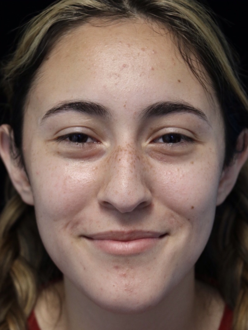 Beverly Hills Rhinoplasty Before & After Gallery - Patient 910591 - Image 5 Dr. Deepak Raj Dugar