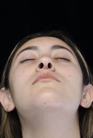 Beverly Hills Rhinoplasty Before & After Gallery - Patient 910591 - Image 8 Dr. Deepak Raj Dugar