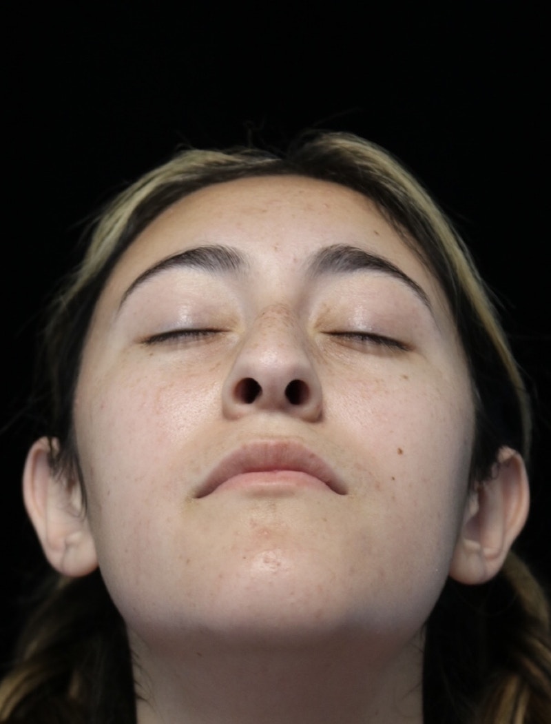 Beverly Hills Rhinoplasty Before & After Gallery - Patient 910591 - Image 7 Dr. Deepak Raj Dugar