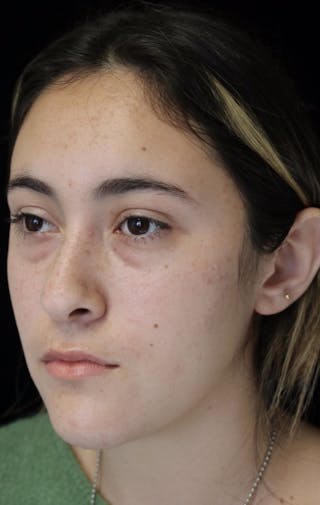 Beverly Hills Rhinoplasty Before & After Gallery - Patient 910591 - Image 10 Dr. Deepak Raj Dugar