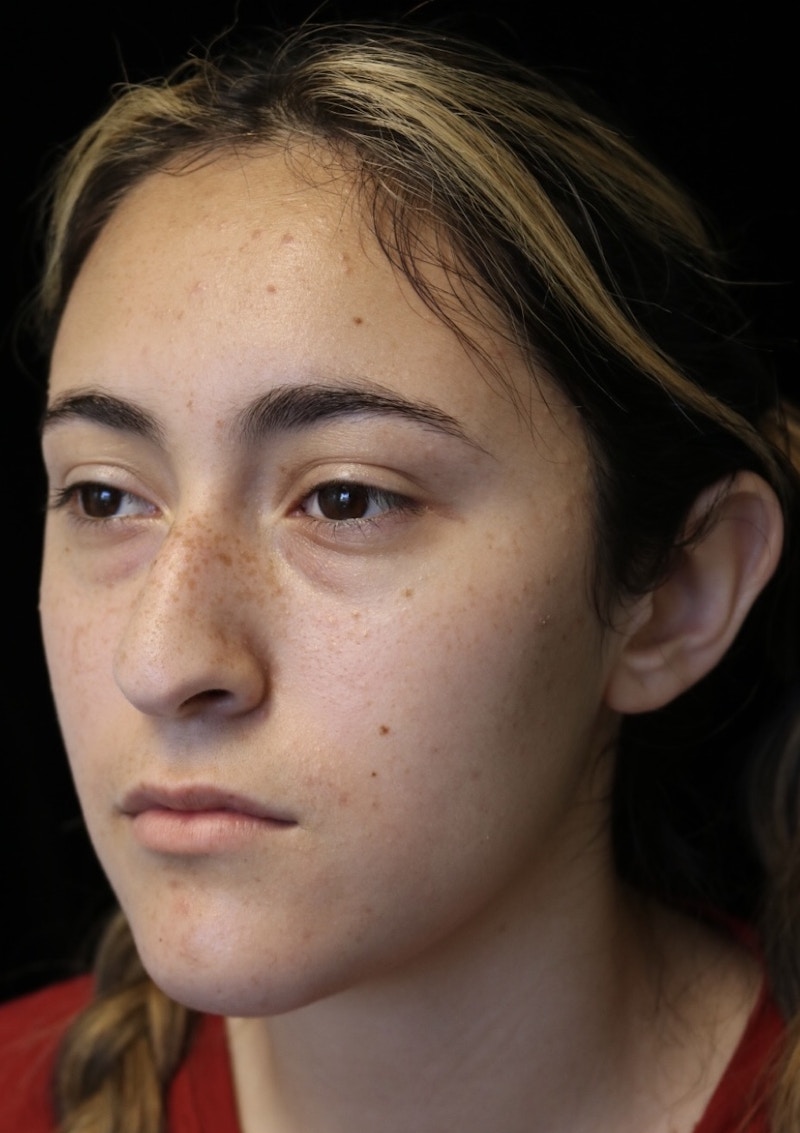 Beverly Hills Rhinoplasty Before & After Gallery - Patient 910591 - Image 9 Dr. Deepak Raj Dugar