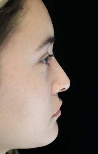 Beverly Hills Rhinoplasty Before & After Gallery - Patient 910591 - Image 2 Dr. Deepak Raj Dugar