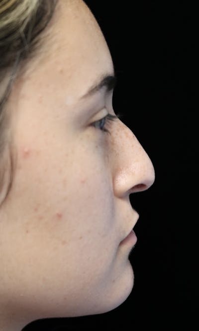Beverly Hills Rhinoplasty Before & After Gallery - Patient 910591 - Image 1 Dr. Deepak Raj Dugar