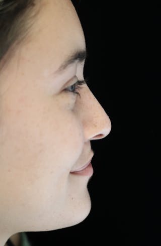 Beverly Hills Rhinoplasty Before & After Gallery - Patient 910591 - Image 12 Dr. Deepak Raj Dugar