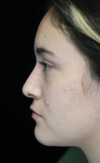 Beverly Hills Rhinoplasty Before & After Gallery - Patient 910591 - Image 14 Dr. Deepak Raj Dugar