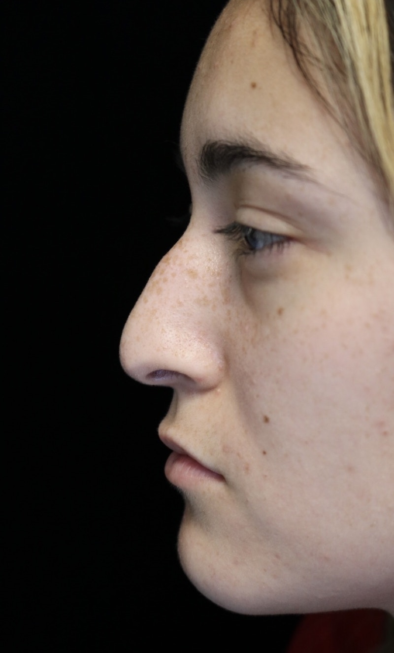 Beverly Hills Rhinoplasty Before & After Gallery - Patient 910591 - Image 13 Dr. Deepak Raj Dugar