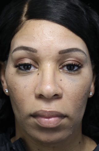 Beverly Hills Rhinoplasty Before & After Gallery - Patient 419477 - Image 4 Dr. Deepak Raj Dugar