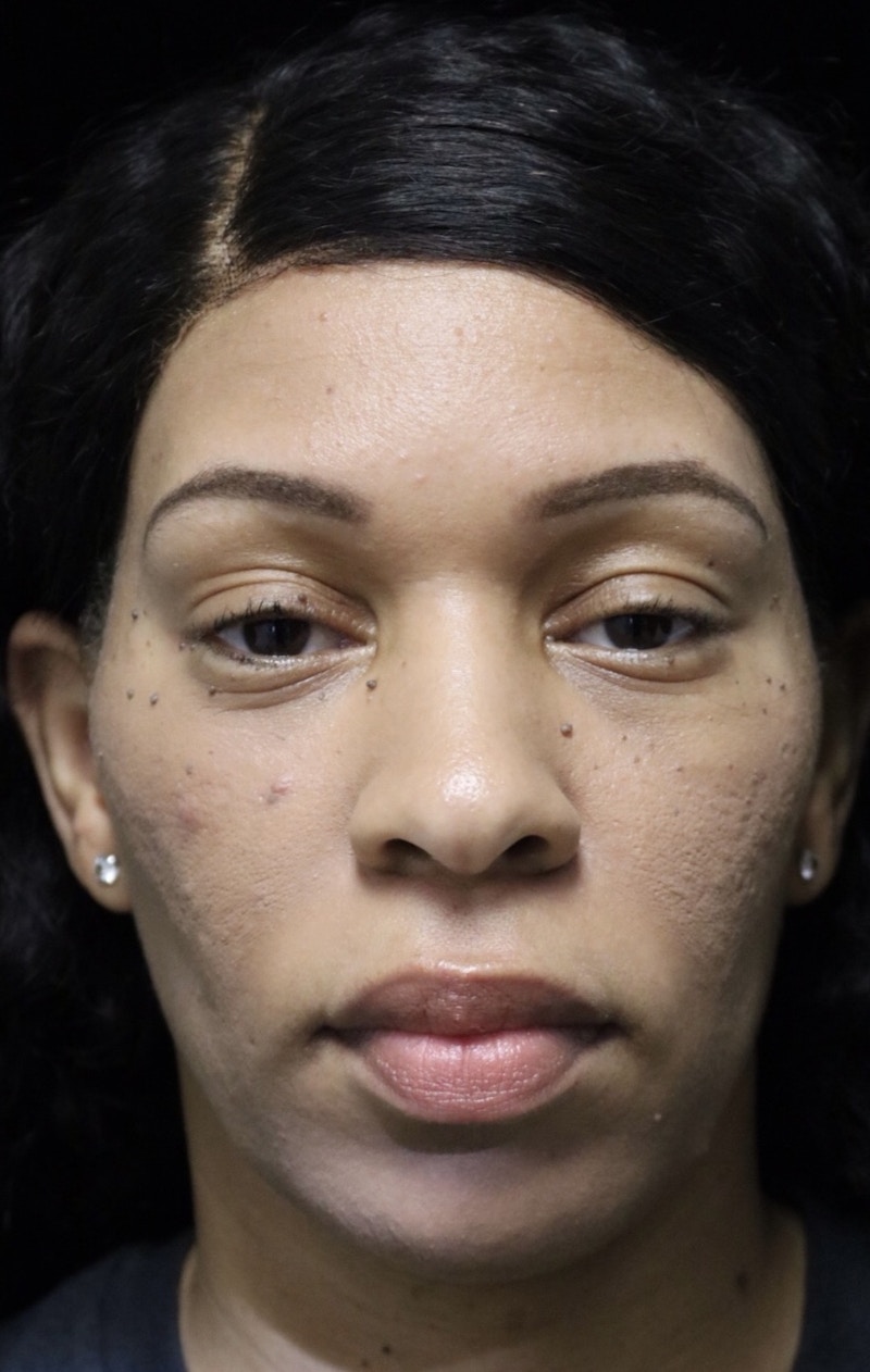 Beverly Hills Rhinoplasty Before & After Gallery - Patient 419477 - Image 3 Dr. Deepak Raj Dugar