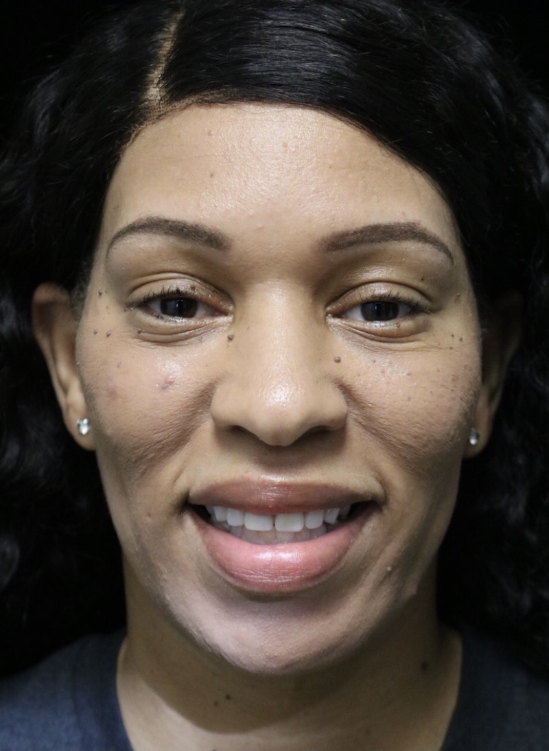 Beverly Hills Rhinoplasty Before & After Gallery - Patient 419477 - Image 5 Dr. Deepak Raj Dugar