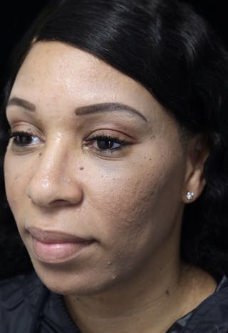 Beverly Hills Rhinoplasty Before & After Gallery - Patient 419477 - Image 10 Dr. Deepak Raj Dugar