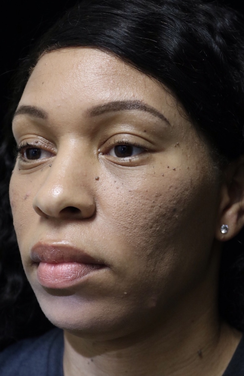 Beverly Hills Rhinoplasty Before & After Gallery - Patient 419477 - Image 9 Dr. Deepak Raj Dugar