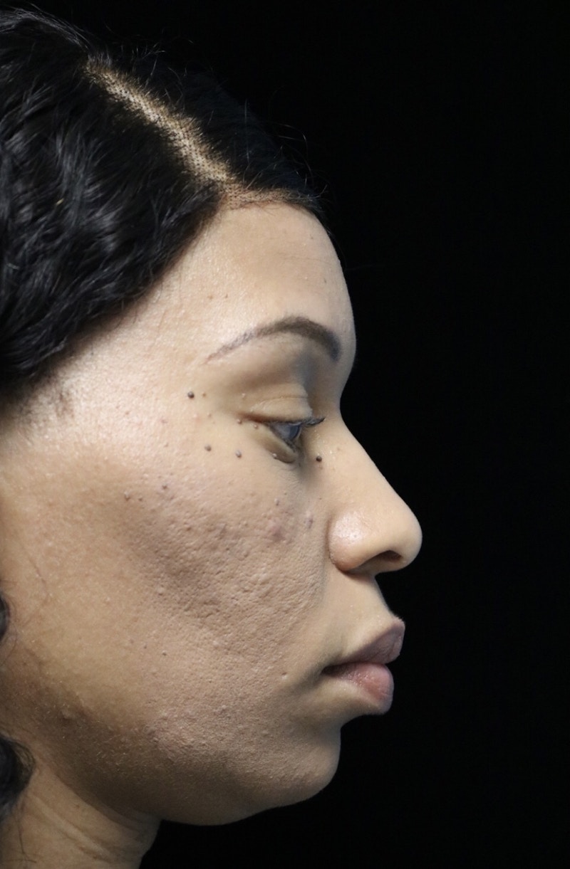 Beverly Hills Rhinoplasty Before & After Gallery - Patient 419477 - Image 1 Dr. Deepak Raj Dugar
