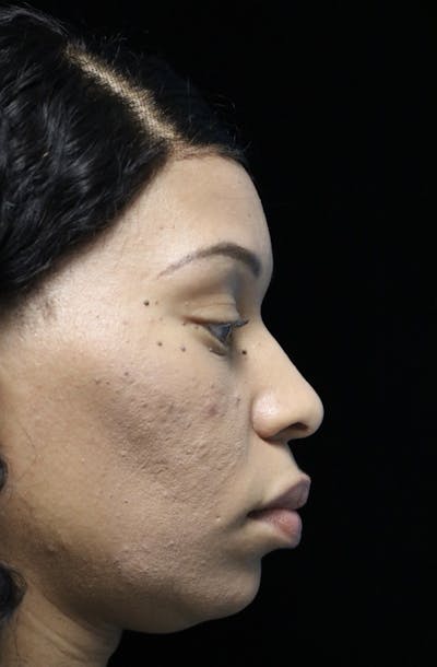 Beverly Hills Rhinoplasty Before & After Gallery - Patient 419477 - Image 1 Dr. Deepak Raj Dugar