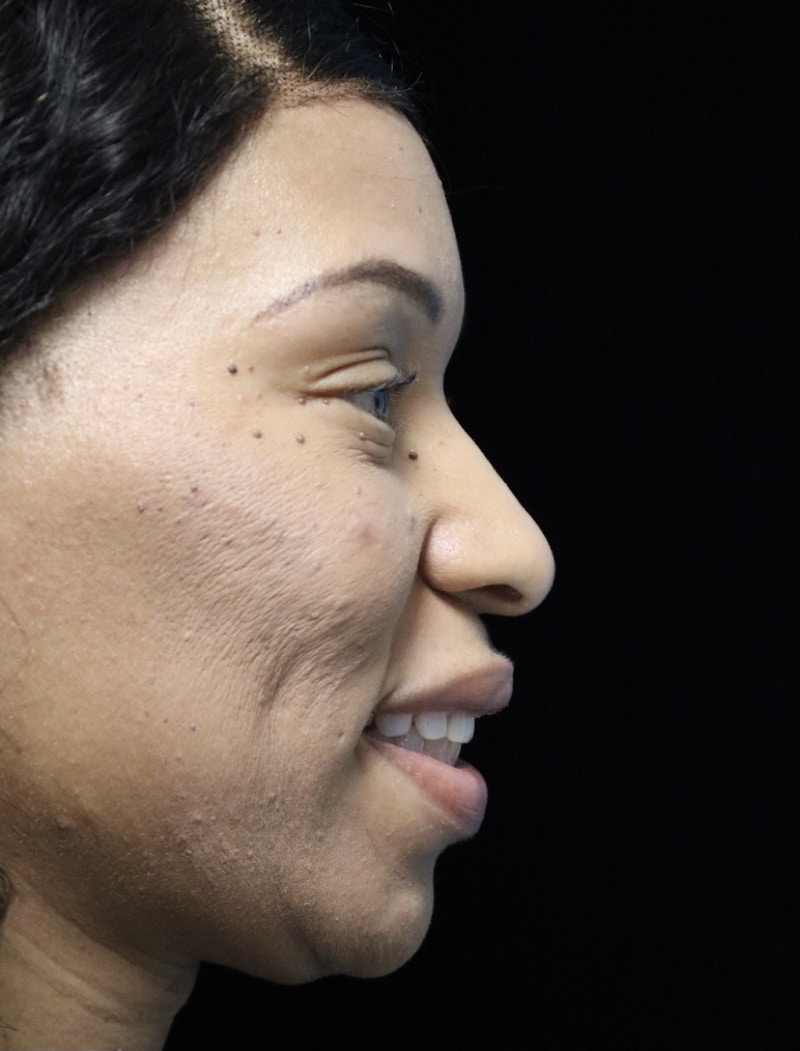 Beverly Hills Rhinoplasty Before & After Gallery - Patient 419477 - Image 11 Dr. Deepak Raj Dugar