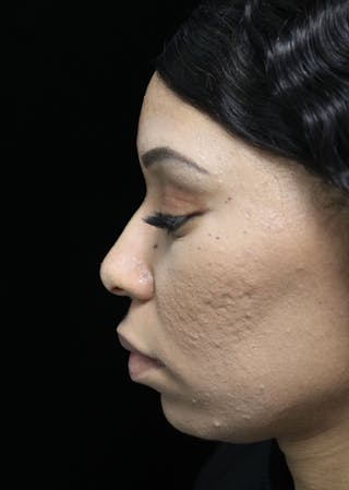 Beverly Hills Rhinoplasty Before & After Gallery - Patient 419477 - Image 14 Dr. Deepak Raj Dugar