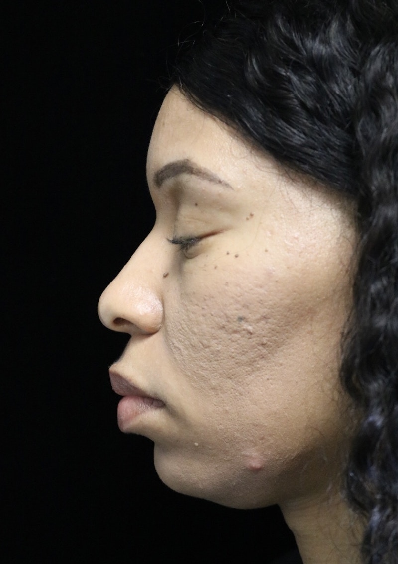 Beverly Hills Rhinoplasty Before & After Gallery - Patient 419477 - Image 13 Dr. Deepak Raj Dugar