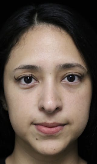 Beverly Hills Rhinoplasty Before & After Gallery - Patient 220247 - Image 4 Dr. Deepak Raj Dugar