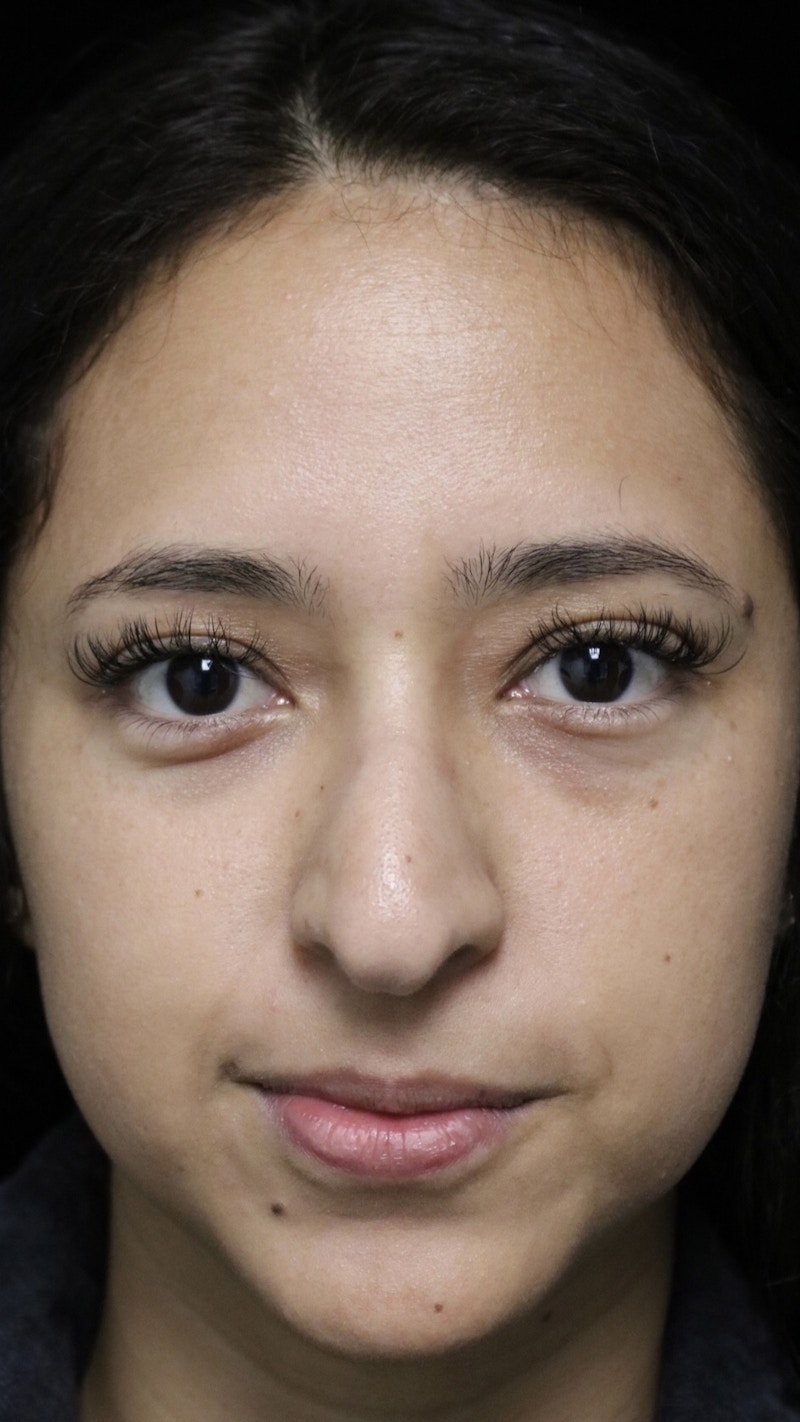 Beverly Hills Rhinoplasty Before & After Gallery - Patient 220247 - Image 3 Dr. Deepak Raj Dugar