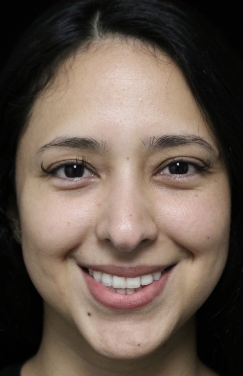 Beverly Hills Rhinoplasty Before & After Gallery - Patient 220247 - Image 6 Dr. Deepak Raj Dugar