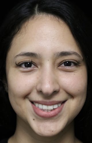 Beverly Hills Rhinoplasty Before & After Gallery - Patient 220247 - Image 6 Dr. Deepak Raj Dugar