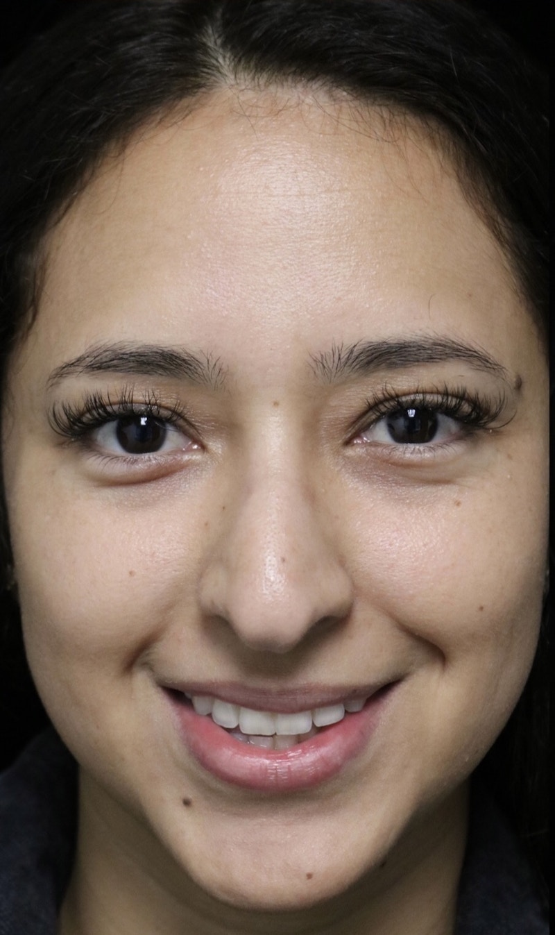 Beverly Hills Rhinoplasty Before & After Gallery - Patient 220247 - Image 5 Dr. Deepak Raj Dugar