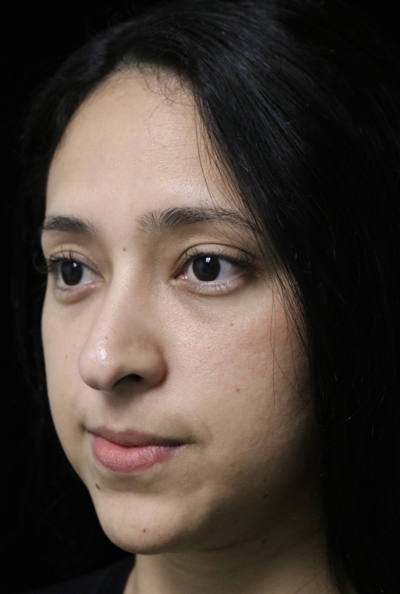 Beverly Hills Rhinoplasty Before & After Gallery - Patient 220247 - Image 10 Dr. Deepak Raj Dugar