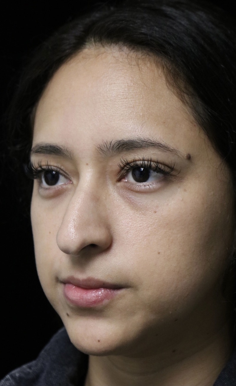 Beverly Hills Rhinoplasty Before & After Gallery - Patient 220247 - Image 9 Dr. Deepak Raj Dugar