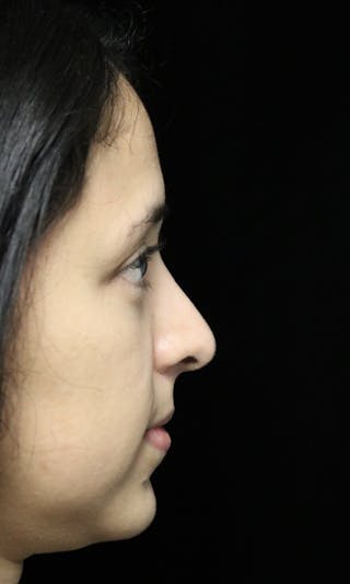 Beverly Hills Rhinoplasty Before & After Gallery - Patient 220247 - Image 2 Dr. Deepak Raj Dugar